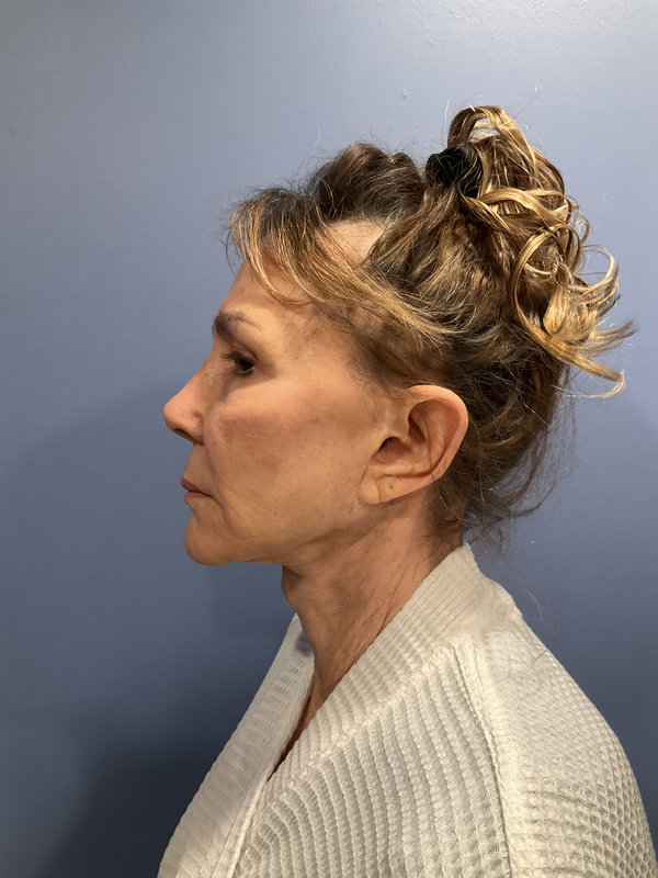 Facelift Before & After Image