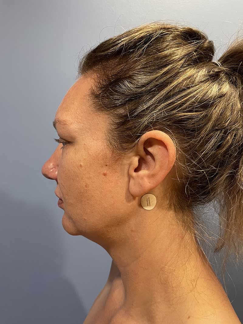 Facial Fat Transfer Before & After Image