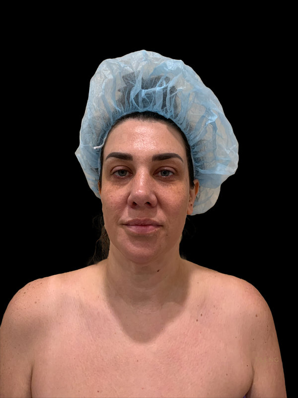 facial fat transfer Before & After Image