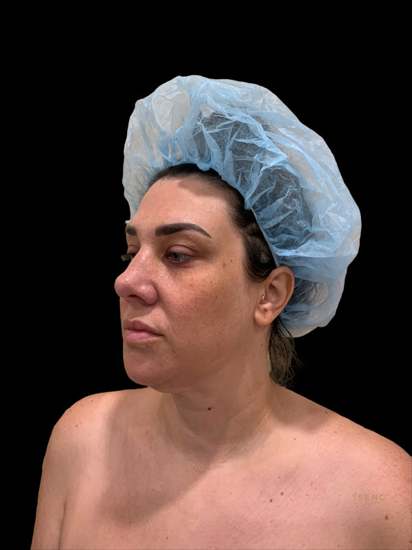facial fat transfer Before & After Image