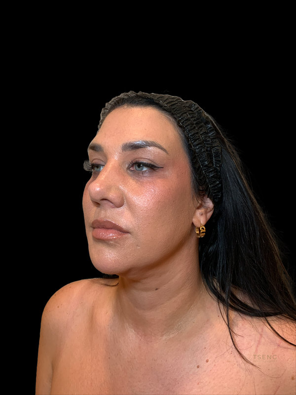 facial fat transfer Before & After Image
