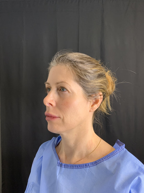 Facial Fat Transfer Before & After Image