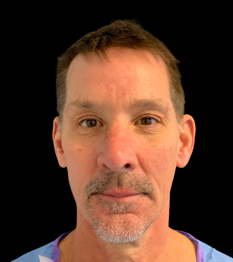 Mini Facelift Before & After Image