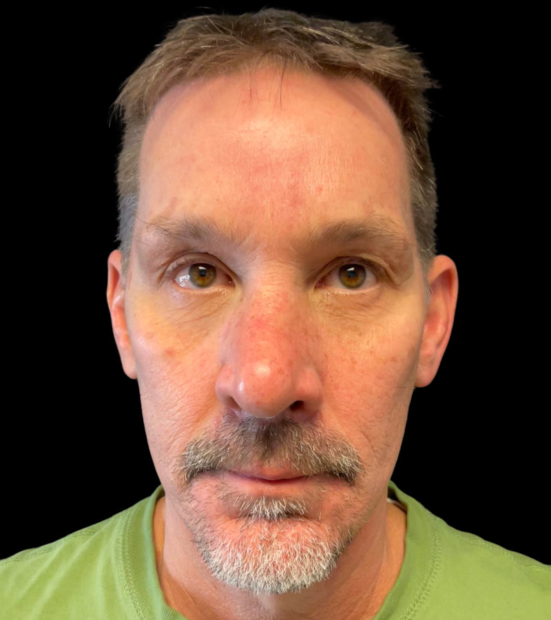 Mini Facelift Before & After Image