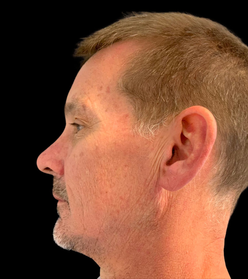 Mini Facelift Before & After Image