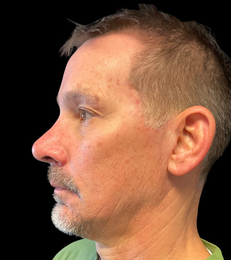 Mini Facelift Before & After Image