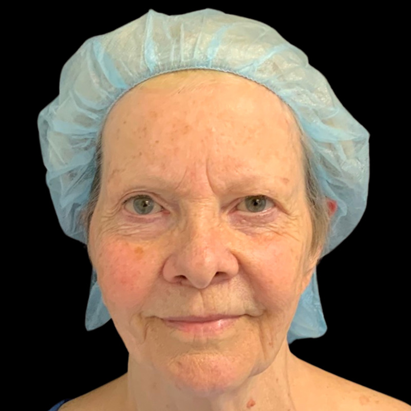 Mini Facelift Before & After Image