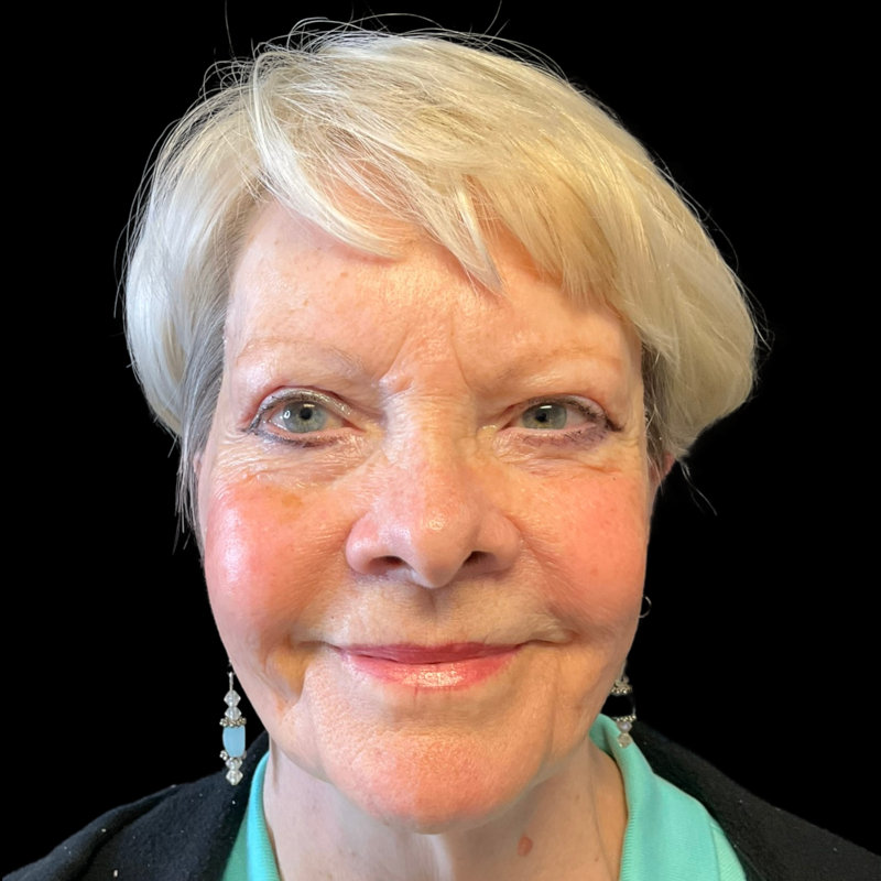 Mini Facelift Before & After Image