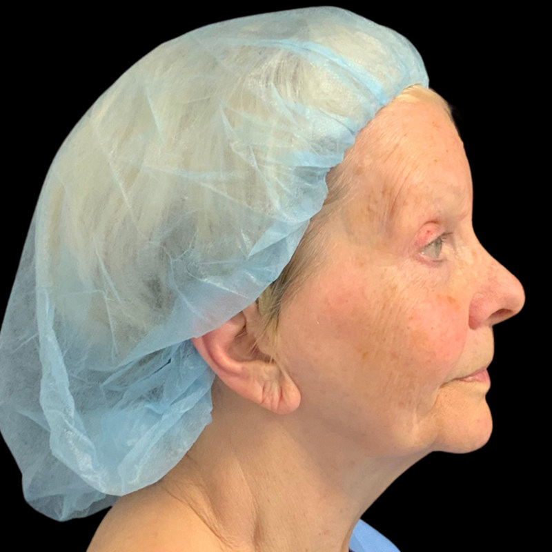 Mini Facelift Before & After Image