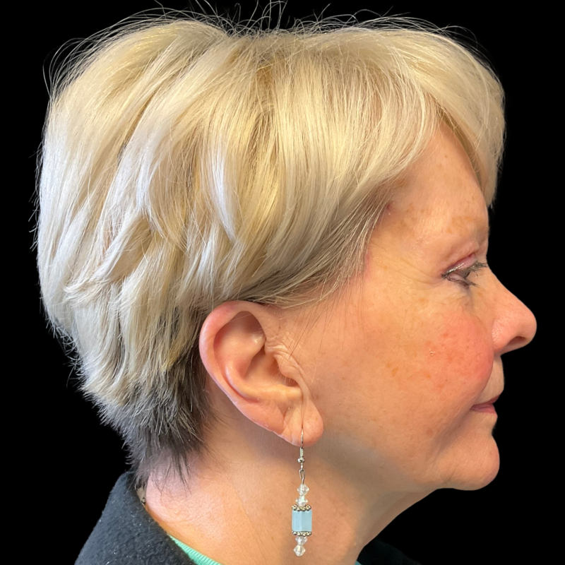 Mini Facelift Before & After Image
