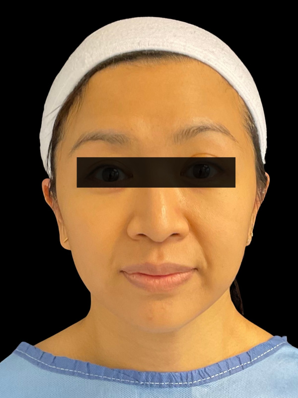 Mini Facelift Before & After Image