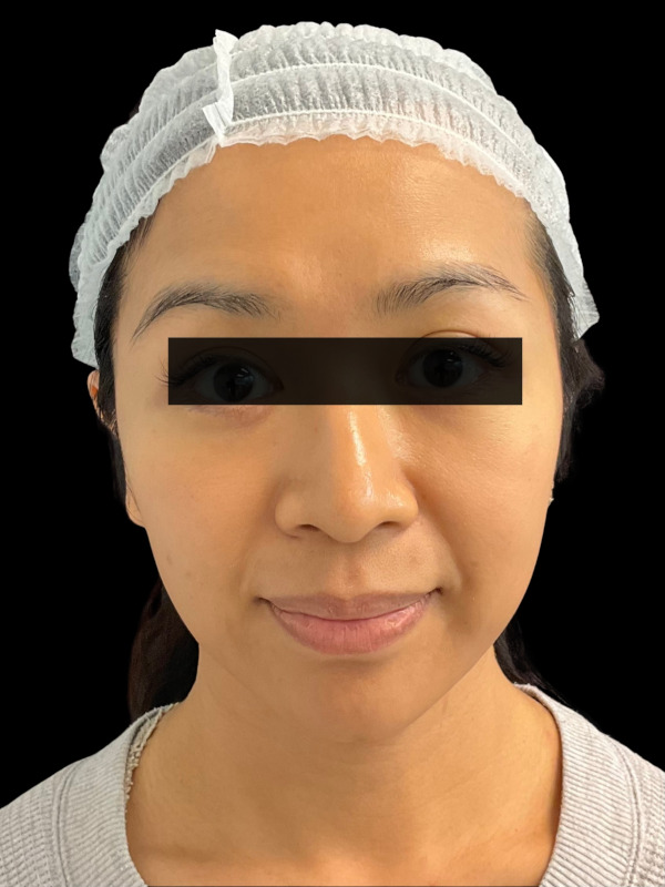 Mini Facelift Before & After Image