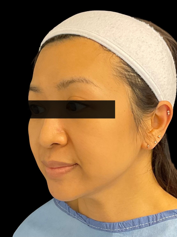 Mini Facelift Before & After Image