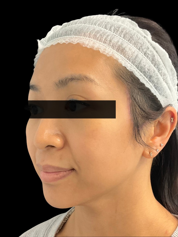 Mini Facelift Before & After Image