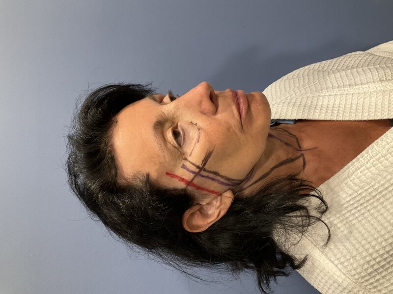 Neck Lift Before & After Image