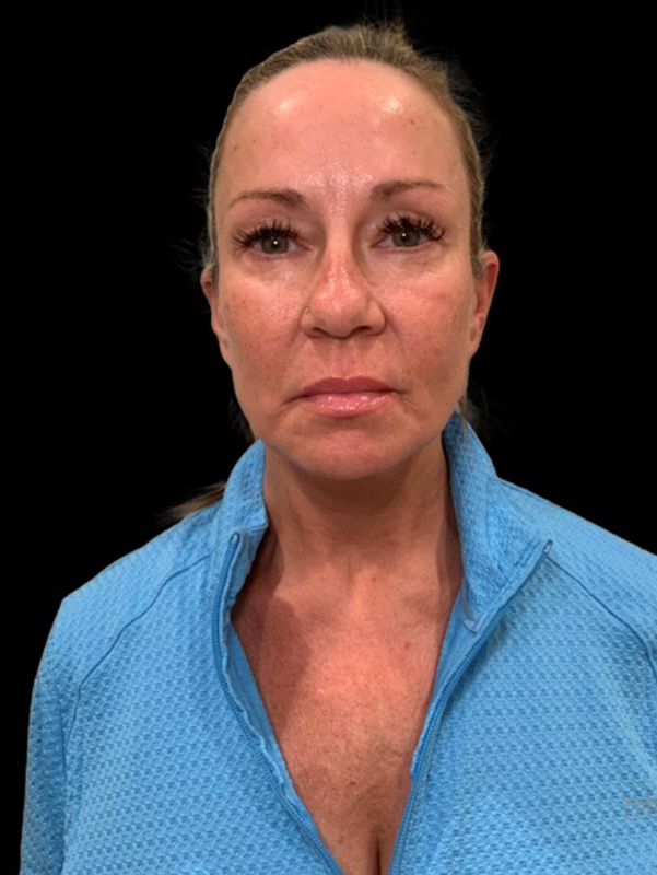 Neck Lift Before & After Image