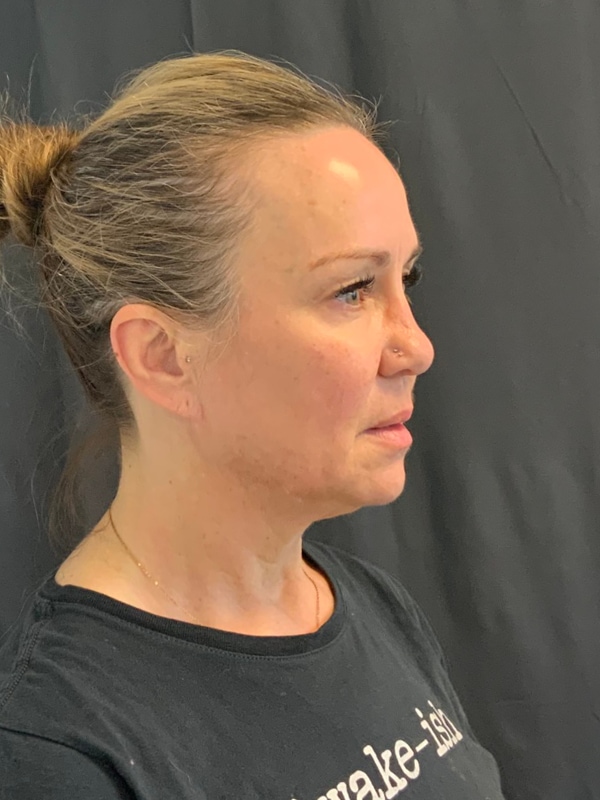 Neck Lift Before & After Image