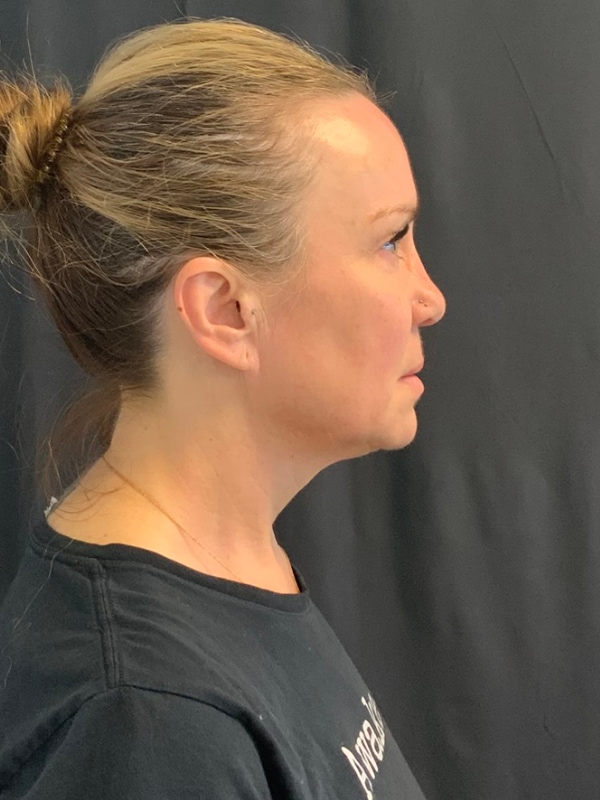 Neck Lift Before & After Image