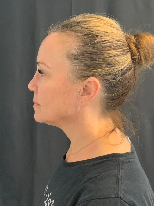 Neck Lift Before & After Image