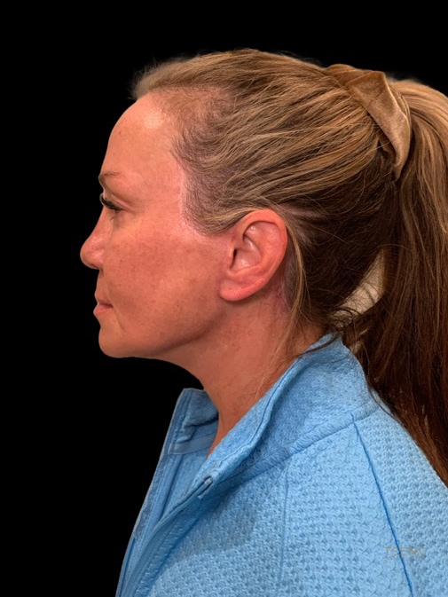 Neck Lift Before & After Image