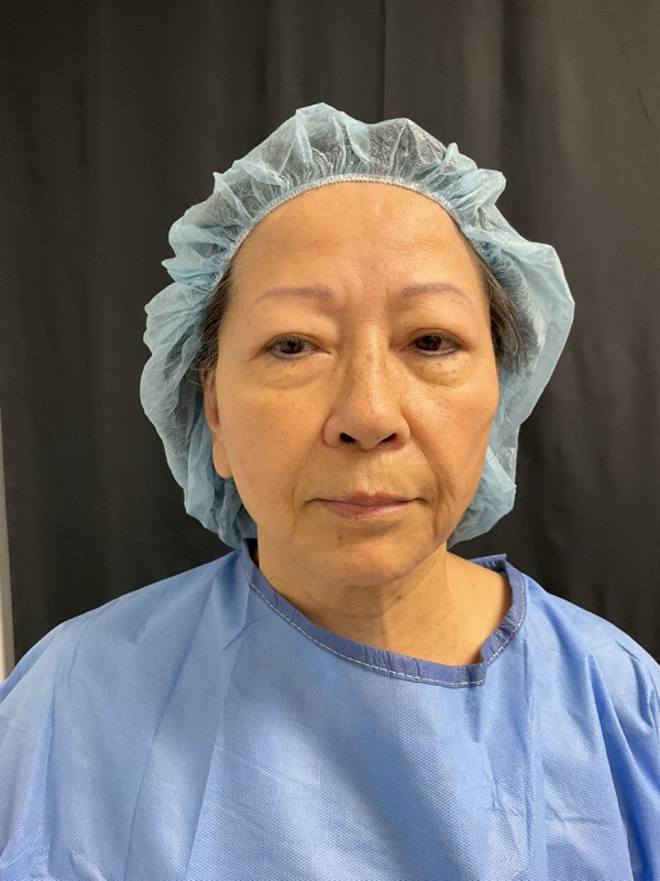 Neck Lift Before & After Image