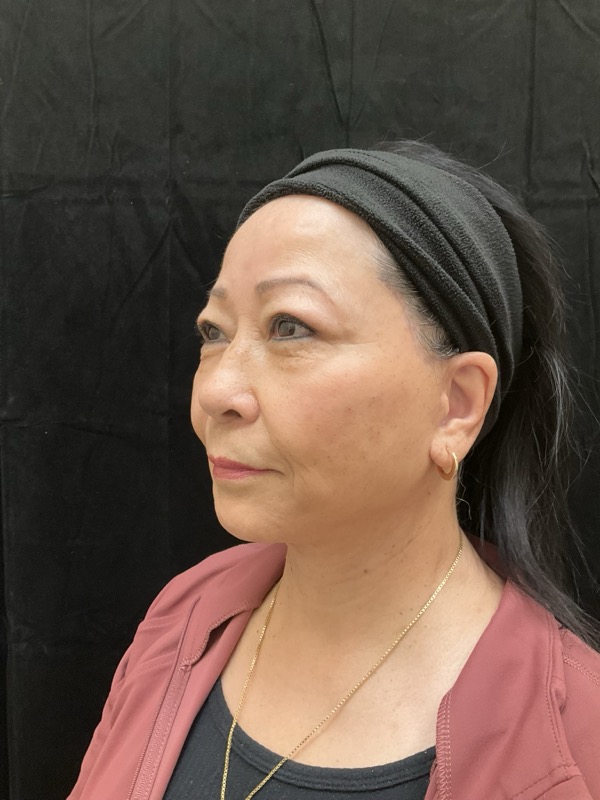 Neck Lift Before & After Image
