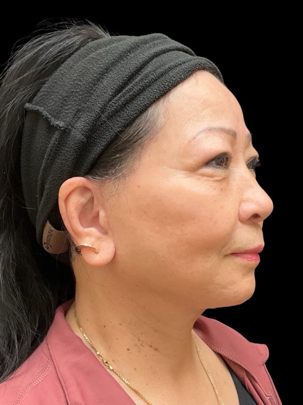 Preservation Facelift Before & After Image