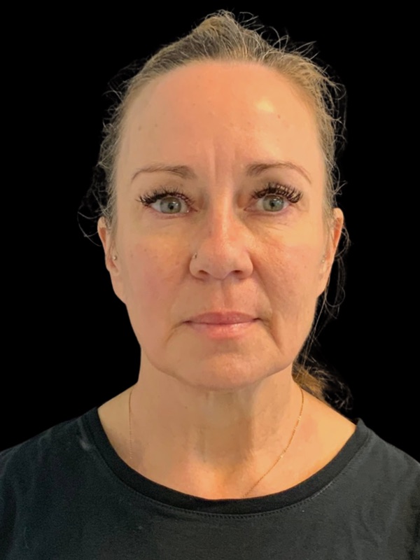Preservation Facelift Before & After Image