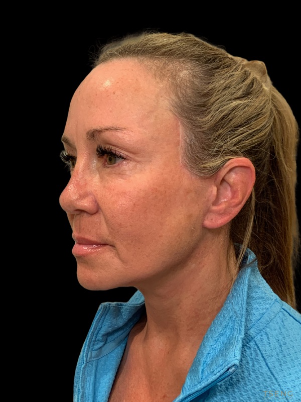 Preservation Facelift Before & After Image