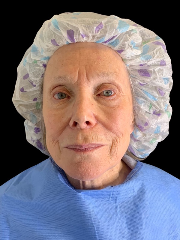Preservation Facelift Before & After Image