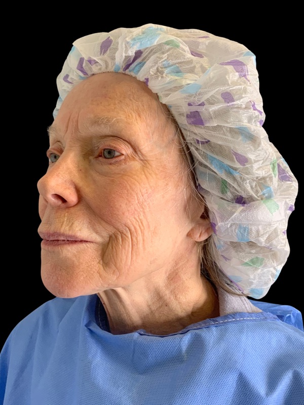 Preservation Facelift Before & After Image