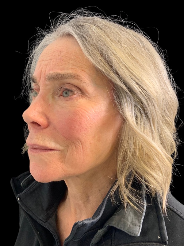 Preservation Facelift Before & After Image
