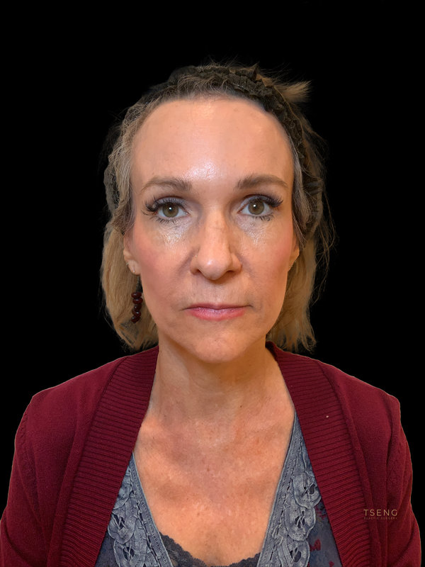 Preservation Facelift Before & After Image
