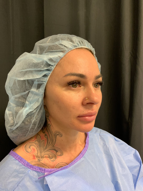 Preservation Facelift Before & After Image