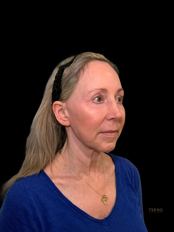 Preservation Facelift Before & After Image