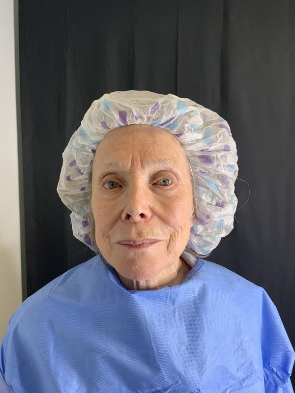 Preservation Facelift Before & After Image