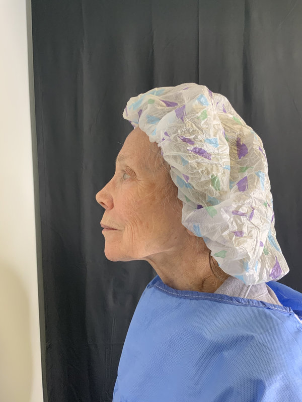 Preservation Facelift Before & After Image