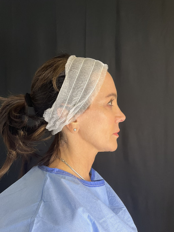 Preservation Facelift Before & After Image
