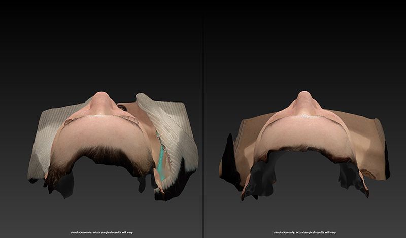 Rhinoplasty Before & After Image