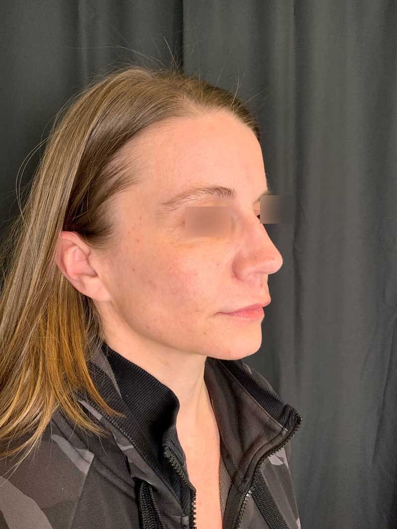 Rhinoplasty Before & After Image