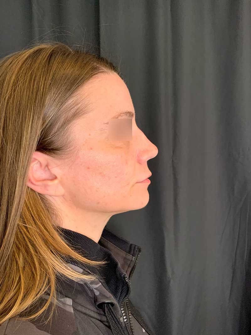 Rhinoplasty Before & After Image