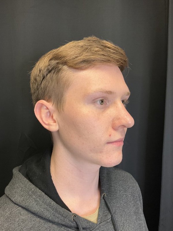 Rhinoplasty Before & After Image