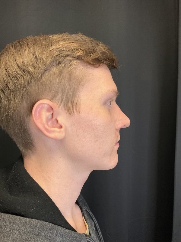 Rhinoplasty Before & After Image