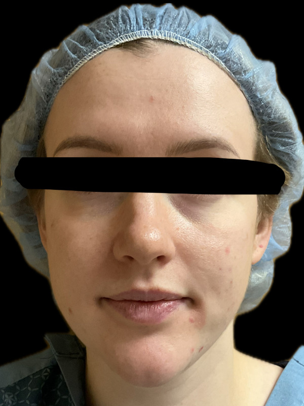 Rhinoplasty Before & After Image