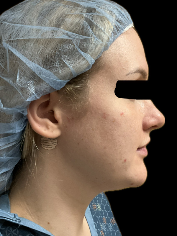 Rhinoplasty Before & After Image