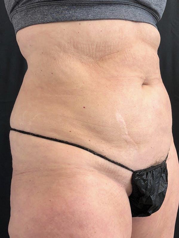 Vaser Liposuction Before & After Image
