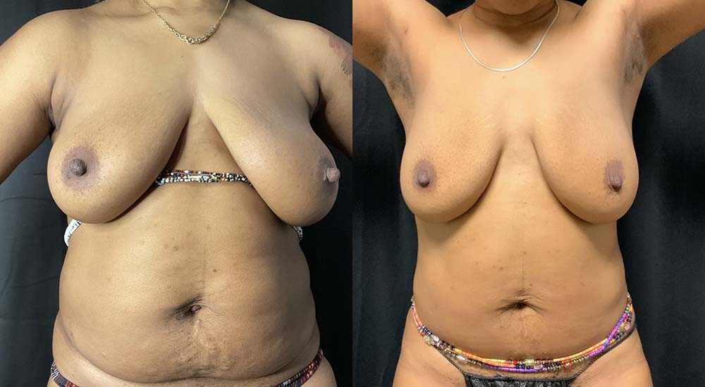 Vaser Liposuction Before & After Image