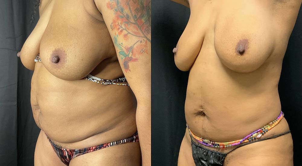 Vaser Liposuction Before & After Image