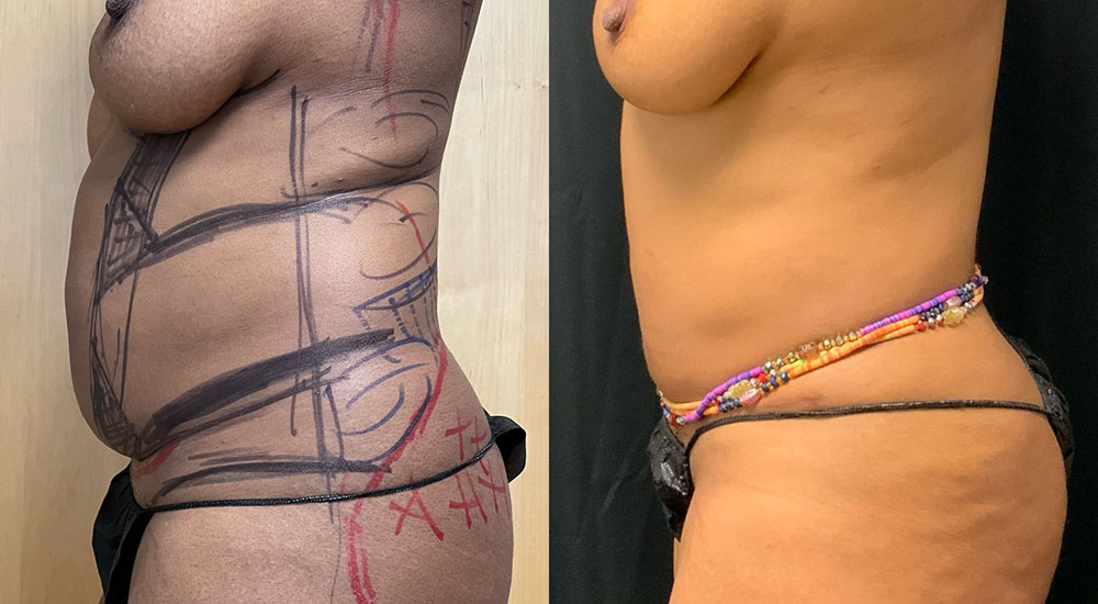 Vaser Liposuction Before & After Image