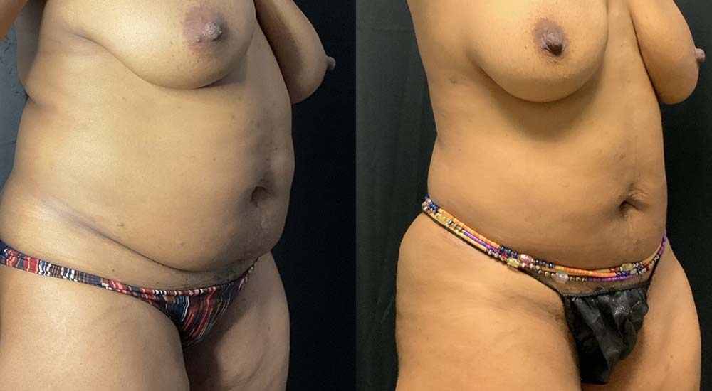 Vaser Liposuction Before & After Image